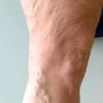 Vein Before & After Patient #424
