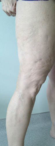 Vein Before & After Patient #424