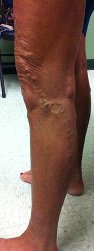 Vein Before & After Patient #430