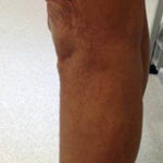 Vein Before & After Patient #430