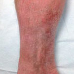 Vein Before & After Patient #435