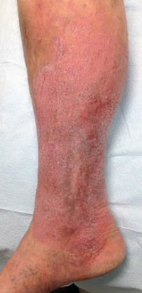 Vein Before & After Patient #435