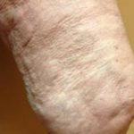 Vein Before & After Patient #439
