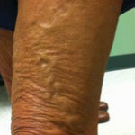 Vein Before & After Patient #443