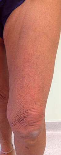 Vein Before & After Patient #443
