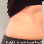BodyFX Before & After Patient #632