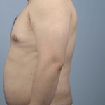 BodyFX Before & After Patient #626