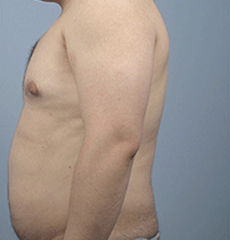 BodyFX Before & After Patient #626