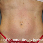 BodyFX Before & After Patient #629