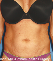 Forma Plus Before & After Patient #668