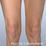 Forma Plus Before & After Patient #677