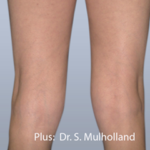 Forma Plus Before & After Patient #677