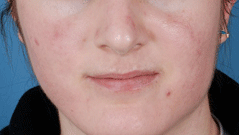 Chemical Peels Before & After Patient #641