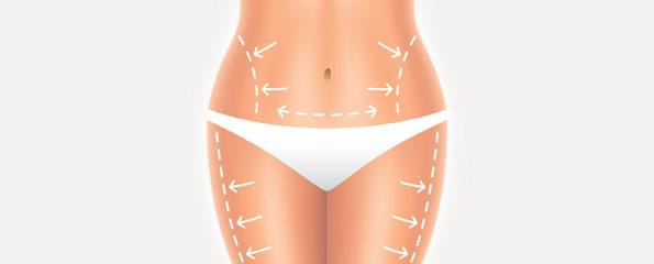 vaser liposuction middlefield